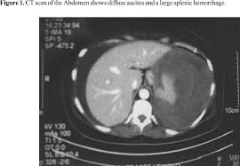 Case Report Spontaneous Rupture Of The Spleen Due To Dengue Fever