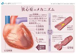 狭心症のメカニズム infographics 医療 看護ノート 医学