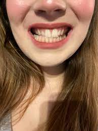 Should I Get Braces I Have A Misaligned Jaw As Seen In The Picture Plus Tmj I Also Have Kindve An Overbite I M Also Hoping Braces Can Help My Front Teeth Not