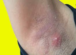 Possible causes of lumps on your armpit, neck or groin; Lumps In Armpit What Is It Breast Cancer Lumps Causes And Treatment