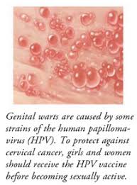 The study, led by the university of nottingham, looked at the sexual practices of more. Genital Human Papillomavirus Hpv