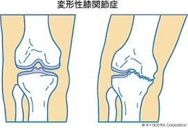 変形性膝関節症の原因｜【阿部 信寛】変形性膝関節症になるのを食い止める保存療法から、外科的治療まで、まず重要なのは「患者さんに合った治療の提案」です。