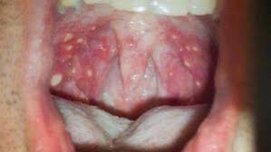 Image result for Canker sores symptoms roof of the mouth