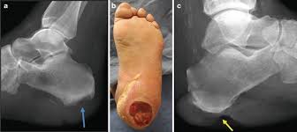 Image result for Osteomyelitis XRay