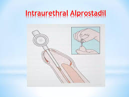 Image result for Intraurethral Alprostadil
