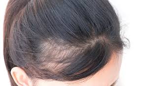 Receding Hairlines in Women: Causes and Treatments