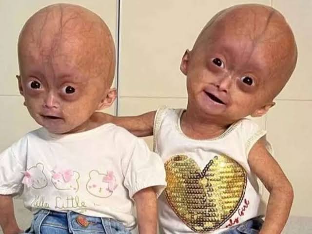 Qual é a doença das gêmeas Elis e Eloá Lima? Entenda a síndrome que levou à  morte da influencer mirim