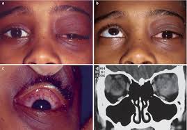 Pediatric Orbital Inflammatory Disorders Ento Key