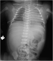 Published by jonah nichols modified over 6 years ago. Properitoneal Fat Mimicking Free Air In An Infant Of A Diabetic Mother Journal Of Perinatology