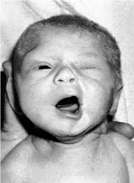 Neonatal Asymmetric Crying Facies: A New Look at an Old Problem