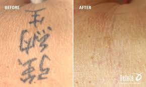 Removal of a tattoo takes time, affords patience, and obviously costs money. Delete Tattoo On Twitter For This Week S Before And After Picoway Tattoo Removal Here Is What We Consider An Easy Removal This All Black Ink Amateur Tattoo Was Located On The Neck