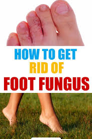 How To Get Rid Of Foot Fungus Home Remedies Treatments Athletes Foot Remedies Foot Remedies Foot Fungus Remedies