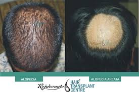 Can anemia cause hair loss? Facts About Hairs Growth And Cycle Hair Transplant Centre