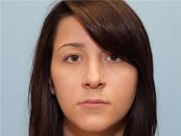 Lip Augmentation/Enhancement Before and After Photos by Paul Vanek, MD,  FACS; Concord, OH