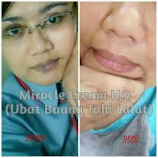 Apakah hukum untuk buang tahi lalat pada badan atau muka kita? 9 Years Challenge Custmr Ubat Buang Tahi Lalat Facebook