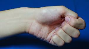 (25) finkelstein's test is typically positive but should not be relied upon as the only finding for diagnosis of dqst. Sehnenscheidenentzundung Hannover Schnellender Finger Tendovaginitis De Quervain