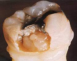 Wurzelglättung (teil der paro behandlung) root planing, subgingival curettage. Ein Loch Im Zahn Wege Der Schmerzfreien Behandlung Beim Zahnarzt