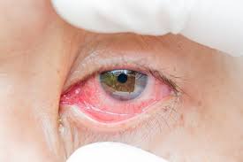 See more ideas about bloodshot eyes, halloween eyeballs, eyes. Coronavirus Symptoms Red Eyes Or Conjunctivitis Are A Potential New Symptom Of Covid 19 Express Co Uk