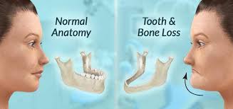 Jawbone Health 1 877 886 1762 Fdg Onesolution Dental Implants