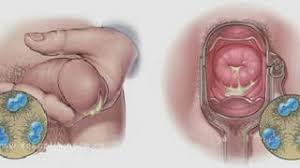 Image result for gonorrhea symptoms