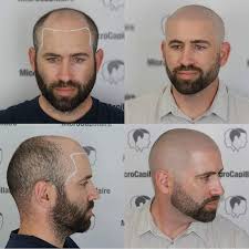 But to make those products as effective as they can be, you should start at the base first. Gallery Microcapillaire Hair Loss Men Healthy Shiny Hair Hair Loss Solutions