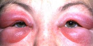 Image result for Allergic Conjunctivitis