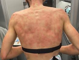 Il fenomeno, verificatosi questa mattina, è stato breve ma violentissimo. Foto Ciclisti Con Schiene Malandate E Arrossate Super Grandinata In Corsa Al Giro Del Delfinato Oa Sport