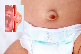 Image result for Inguinal hernia child