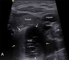 We did not find results for: A Symptomatic Killian Jamieson Diverticulum Detected By Ultrasonography