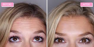 How to get rid of lines between eyebrows. Botox Review 9 Things You Need To Know Before Having It