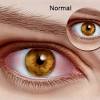 Keratitis may or may not be associated with an infection. 1