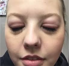 Allergic Reactions To Eyelash Extensions Lash Tavern Eyelash Extensions Eyelash Extensions Care Eyelash Extentions
