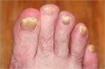 toenail fungus treatment nail