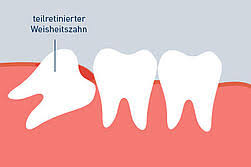 Müssen alle weisheitszähne gezogen werden? Weisheitszahn Op Ablauf Risiken Kosten