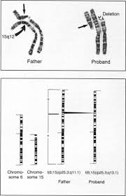 Prader Willi Syndrome And Angelman Syndrome In Cousins From