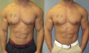 Gynecomastia Surgery UAE Cost 2024