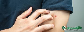 Image result for mosquito bite