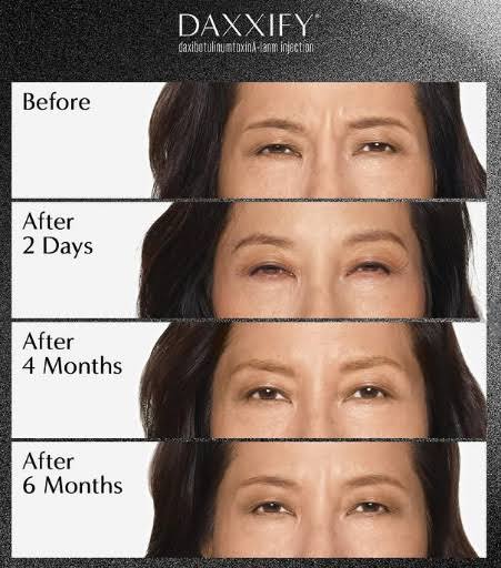 Facial Line Smoothing Progression, 