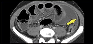We did not find results for: The Radiology Assistant Peritoneal Pathology