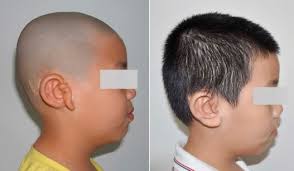 Vibrant SoundBridge combined with auricle reconstruction for bilateral  congenital aural atresia