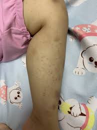 ８歲女童四肢佈滿紅點瘀青竟是紫斑症作祟- 自由健康網