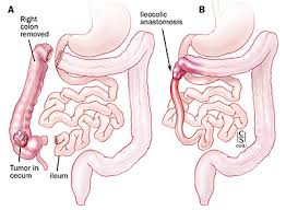 The healing of colonic anastomoses is slower and accompanied by more complications than healing elsewhere in the gastrointestinal tract. ç›´è‚›å¤–ç§' Colorectal Resections ç™½è¢ææ‡¼ç—‡ ç—žå®¢é‚¦