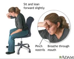 Hidung berdarah, juga dikenali sebagai epistaxis, ialah kejadian biasa pendarahan dari hidung. Pengalaman Anak Hidung Berdarah Dan Cara Merawatnya Secara Semulajadi