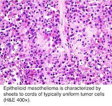 Radiologic appearances correlated with histology. Pathology Outlines Peritoneal Malignant Mesothelioma