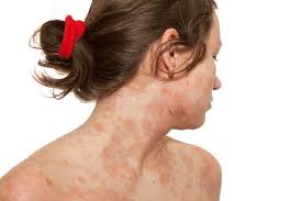 Image result for Eczema nummulare