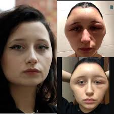 One of the main culprits is paraphenylenediamine or ppd. Wish Fm On Twitter Shocking Lady S Head Expands After Using Hair Dye 19 Year Old Estelle From Paris Shared Photos Showing Her Shocking Disfigurement Caused By The Chemical Ppd Which Is Found In
