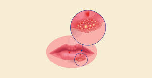 Image result for scabies on genitals