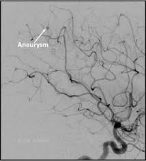 Saccular cerebral aneurysms, also known as berry aneurysms, are intracranial aneurysms with a characteristic rounded shape. Brain Aneurysm Radiology
