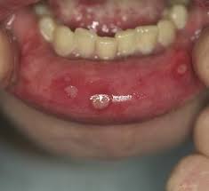 Lupus And Oral Health Lupus Discoid Lupus Oral Health