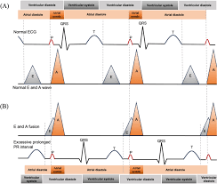 Image result for PR Interval